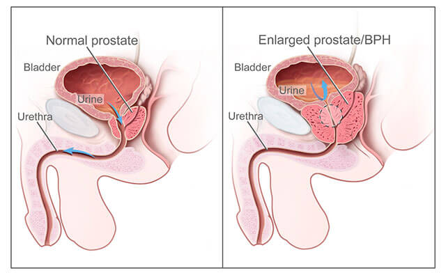 Zvětšená prostata - benigní prostatická hyperplazie (BPH)