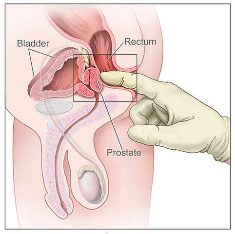 Rektální vyšetření prostaty
